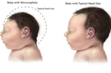 Có một sự liên hệ giữa việc nhiễm virus Zika trong thời điểm thai kỳ của người mẹ và chứng não nhỏ ở trẻ sơ sinh (ảnh minh họa, nguồn: Internet)